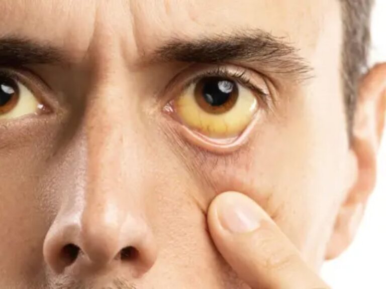 Hepatitis, el enemigo silencioso que mata a 1.3 millones al año