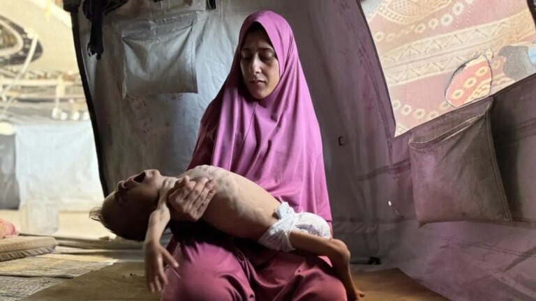 Mohamed, la historia del bebé desnutrido que muestra la hambruna extrema en Gaza
