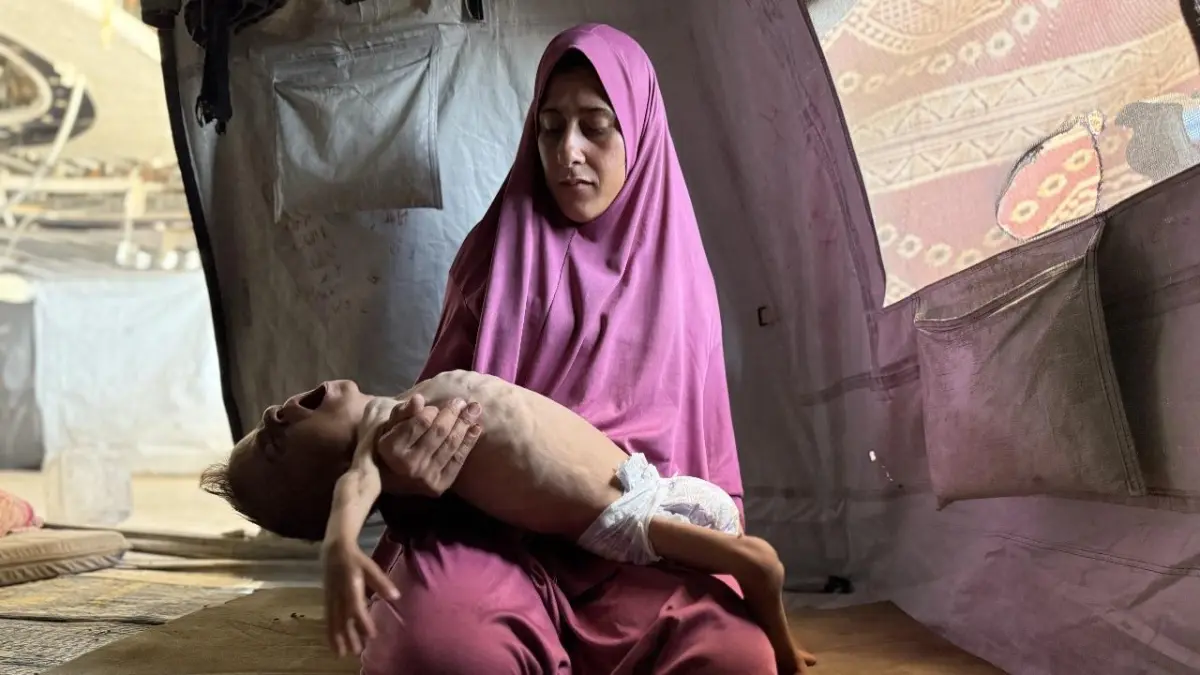 Mohamed, la historia del bebé desnutrido que muestra la hambruna extrema en Gaza