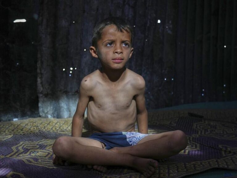 Cifra de niños muertos en Gaza por desnutrición se eleva a 100