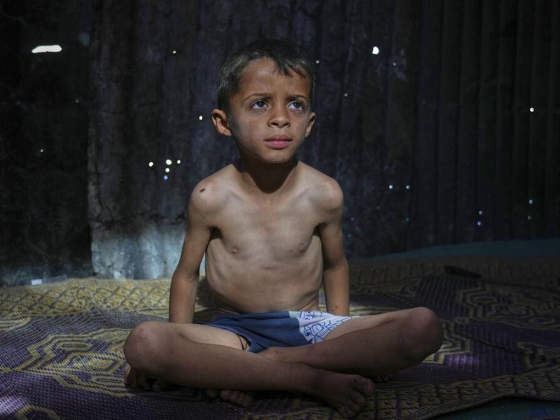 Cifra de niños muertos en Gaza por desnutrición se eleva a 100