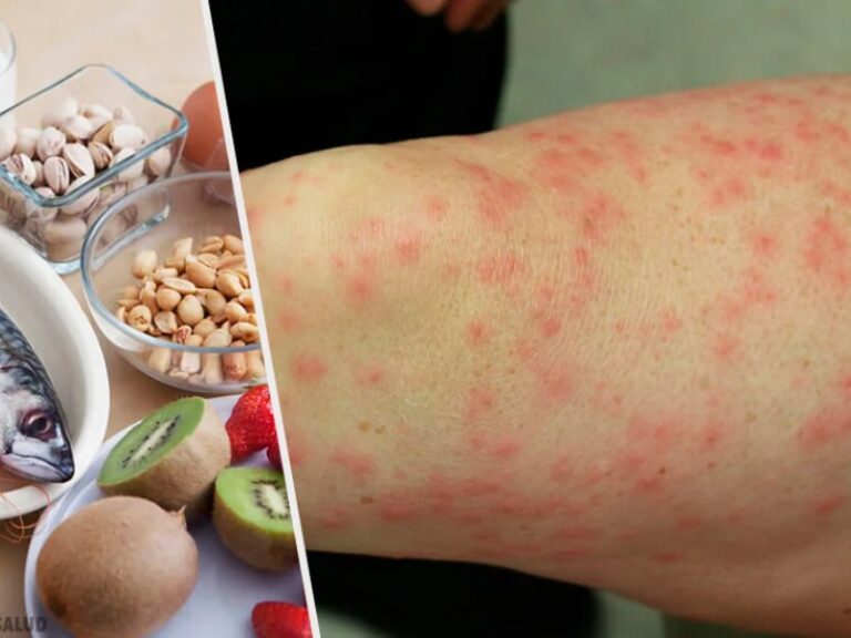 Descubren cómo evitar reacciones alérgicas graves por alimentos